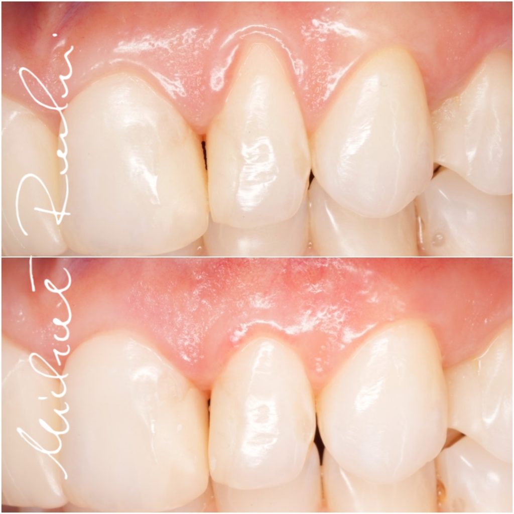 Periodontologia – efekt leczenia w gabinecie dr. Rawickiego w Bydgoszczy (1)